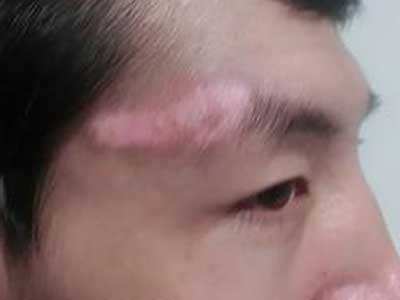 長春博潤皮膚病醫院