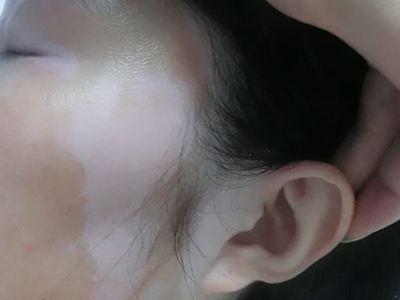 長春博潤皮膚病醫(yī)院