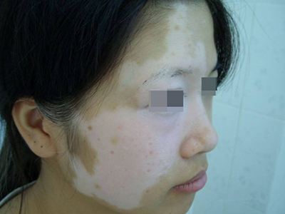 長春博潤皮膚病醫院